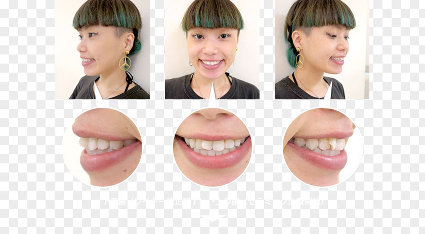 Orthodontic Correction Lip Cheek Mouth Chin Jaw PNG