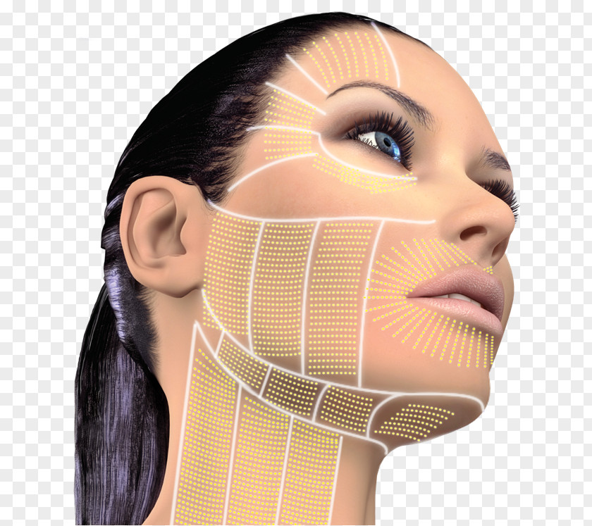 Face High-intensity Focused Ultrasound Surgery Rhytidectomy Skin Wrinkle PNG