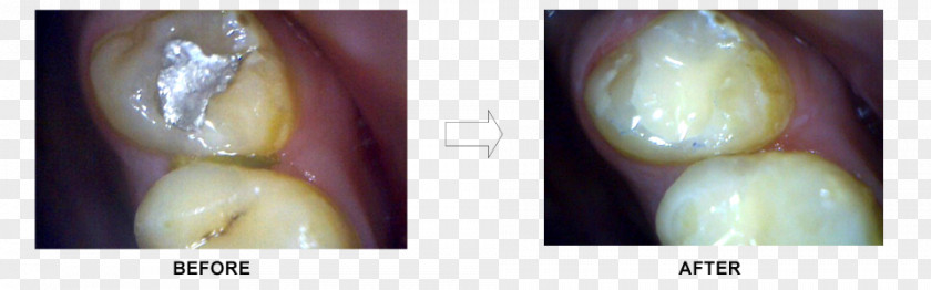 Fill A Tooth Ceramco Dental Clinic Borivali Dentist Nand Dham Appartments Mouth Jaw PNG