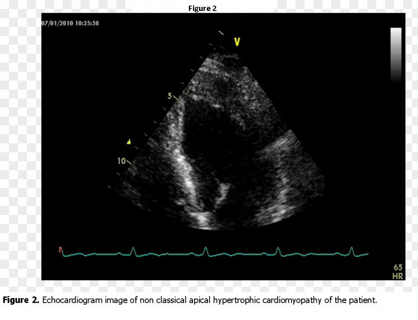 Hypertrophic Cardiomyopathy Medical Imaging Radiology Medicine Phenomenon Font PNG