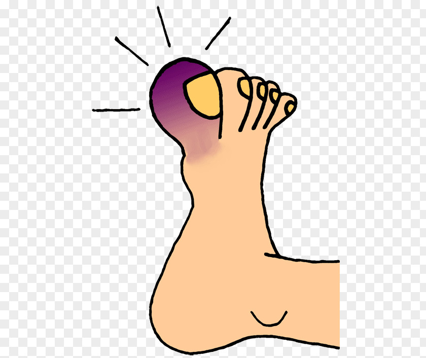 Nail Toe Foot Onychocryptosis Clip Art PNG
