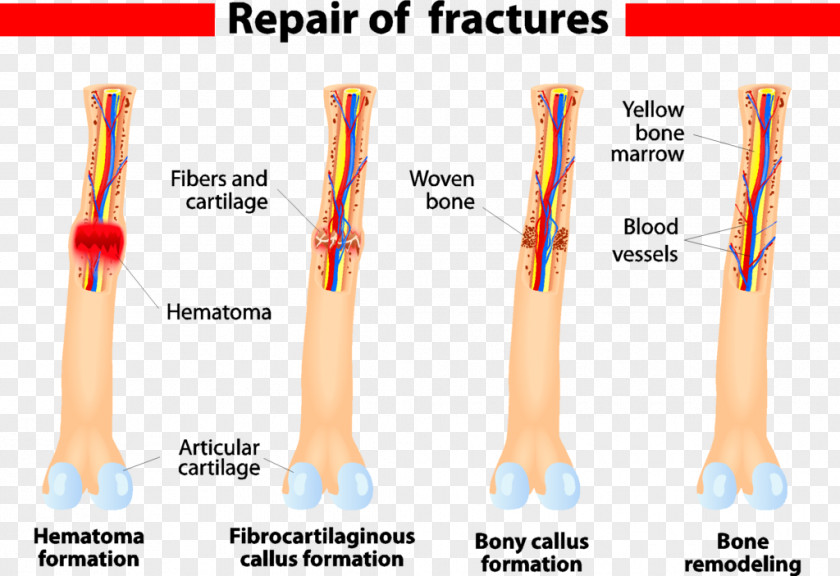 Bone Fracture Healing Wound PNG