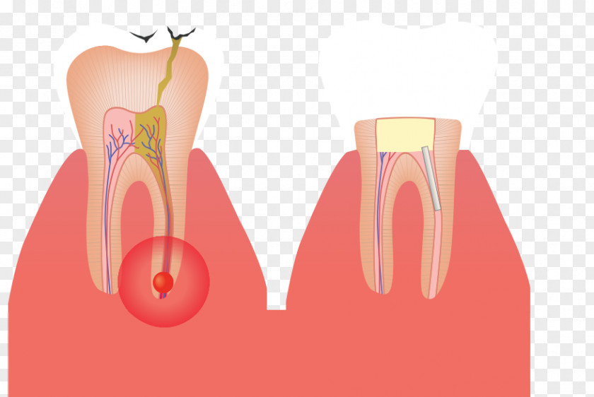 Root Canal Shoulder Tooth Gross Anatomy PNG