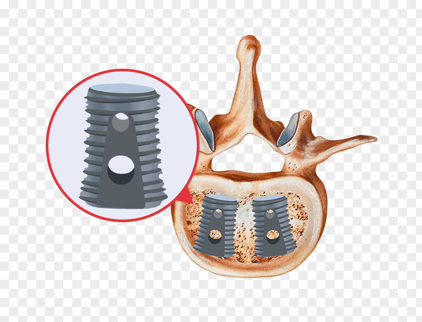 Bone Grafting Spinal Fusion Morphogenetic Protein Implant PNG