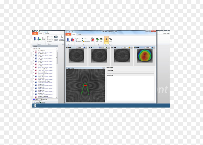 Corneal Topography Surveyor Computer Software Orthokeratology PNG
