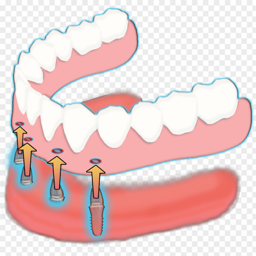 Rail Dental Tooth Mini Implants: Principles And Practice Complete Dentures PNG