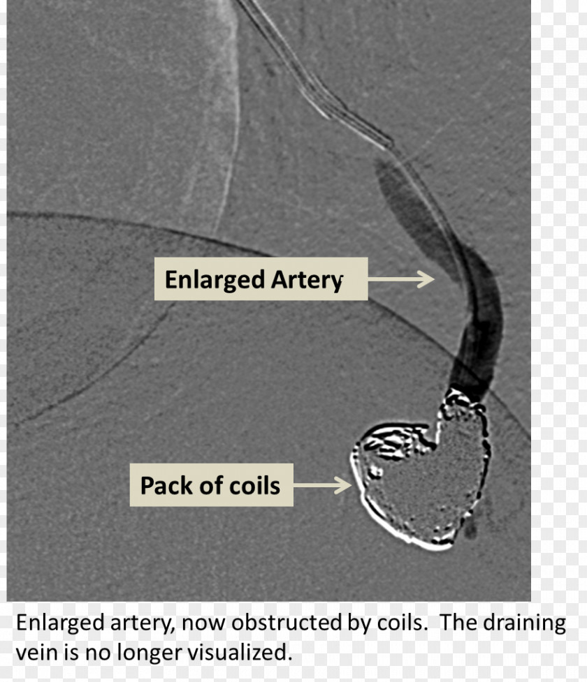Cerebral Arteriovenous Malformation Lung Malformacja Embolization PNG