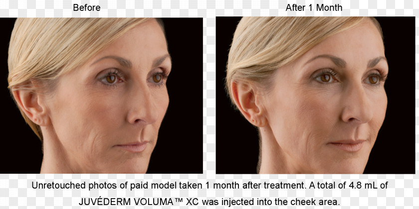 Nose Injectable Filler Juvéderm Cheek Nasolabial Fold PNG