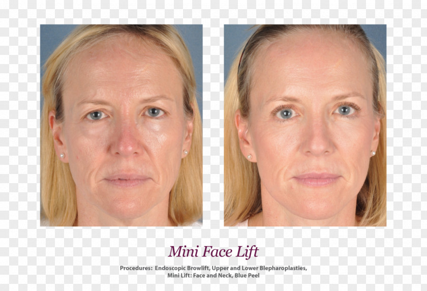 Mini Facelift Skin Face Rhytidectomy Wrinkle Surgery PNG