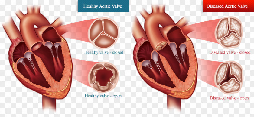 Calculation Of Ideal Weight Valvular Aortic Stenosis Valve Replacement Heart Disease Balloon Valvuloplasty PNG