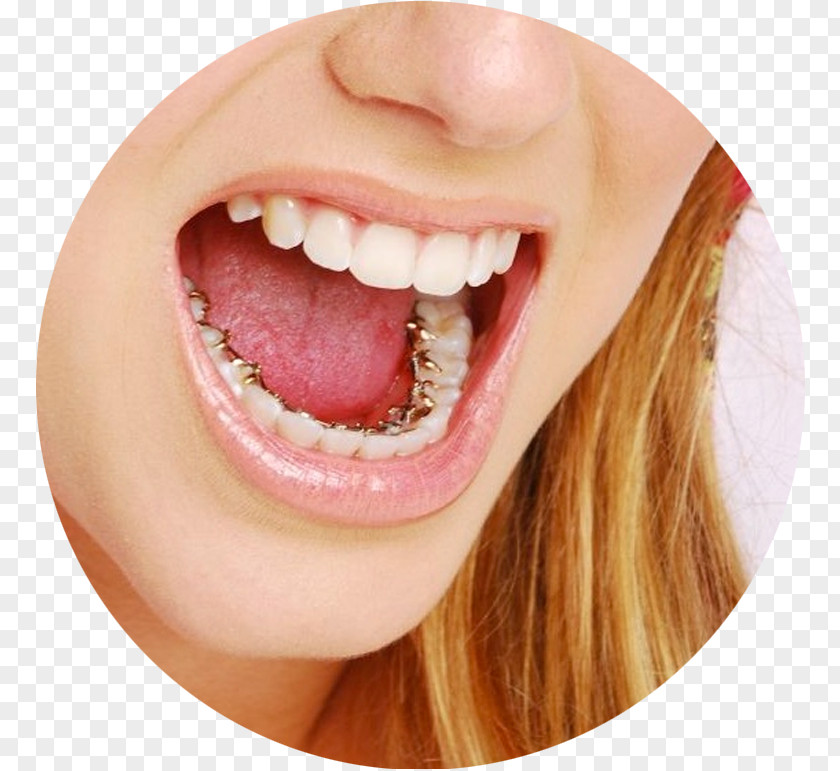 Dental Braces Castleknock Orthodontics Lingual Clear Aligners PNG