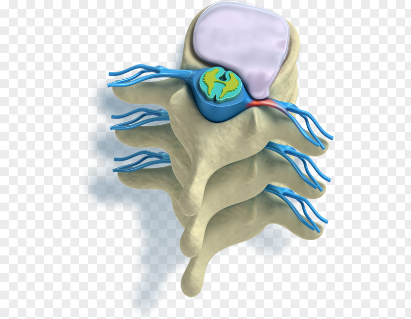 Pain In Spine Vertebral Column Spinal Disc Herniation Radicular Intervertebral PNG
