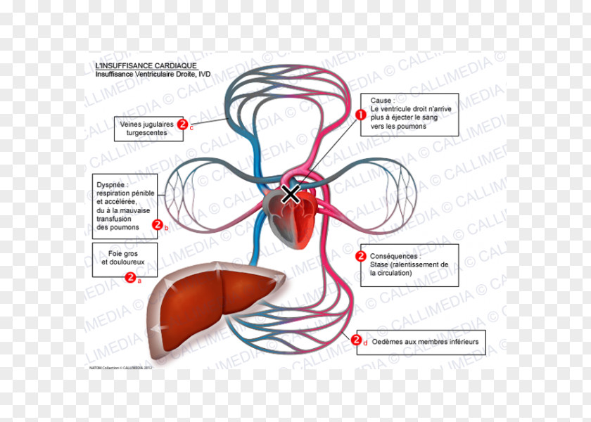 Heart Failure Right Ventricle Lung Electrocardiography PNG
