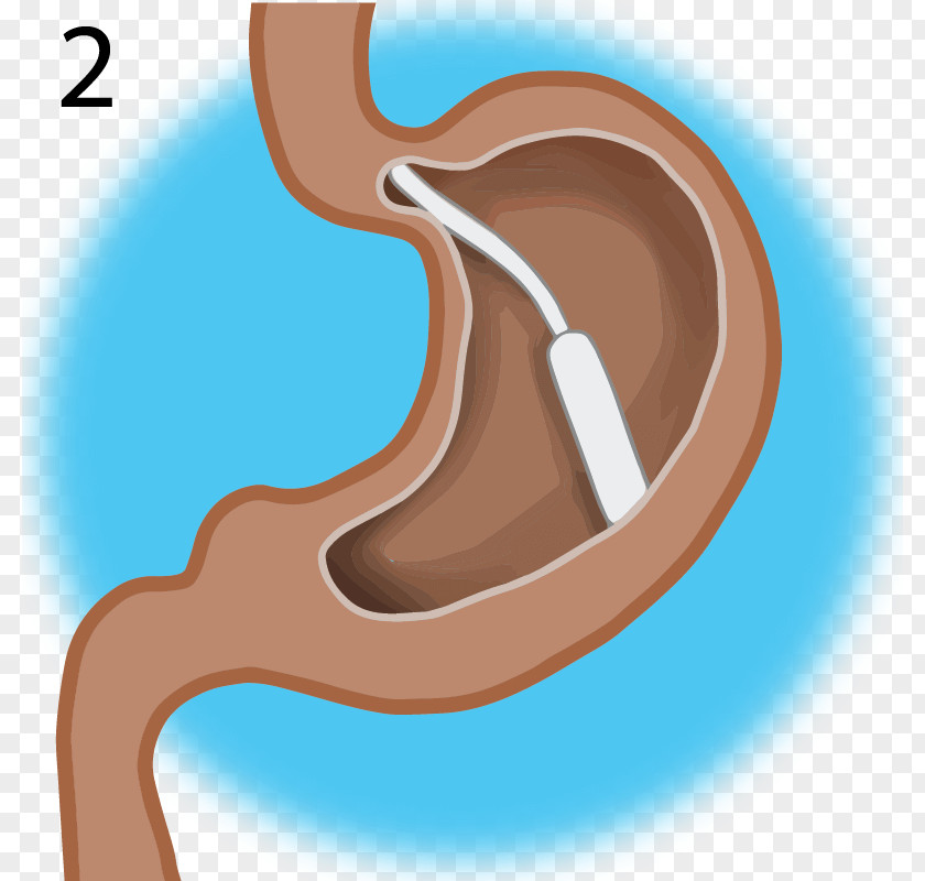 Gastric Obesity Disease 减肥 Weight Loss Shoulder PNG