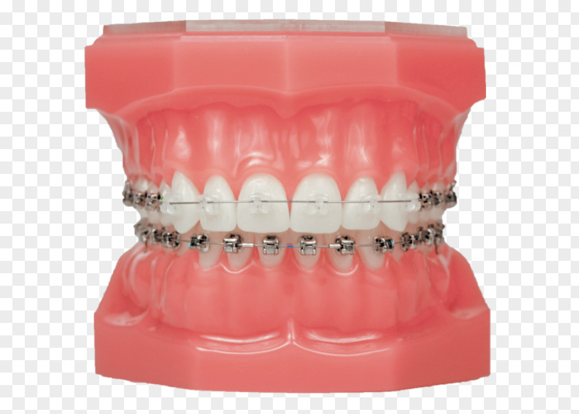 Invisalign Damon System Dental Braces Clear Aligners Orthodontics Self-ligating Bracket PNG