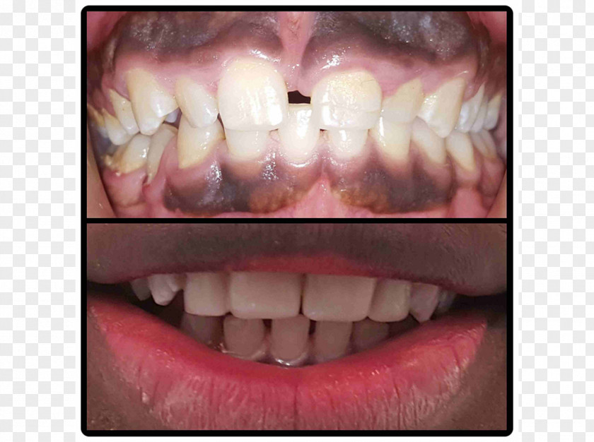 Crown Tooth Veneer Dental Implant All-on-4 Dentistry PNG