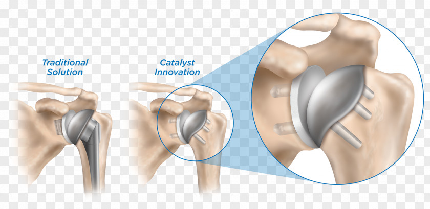 Strengthen Protection Shoulder Replacement Implant Surgery Humerus PNG