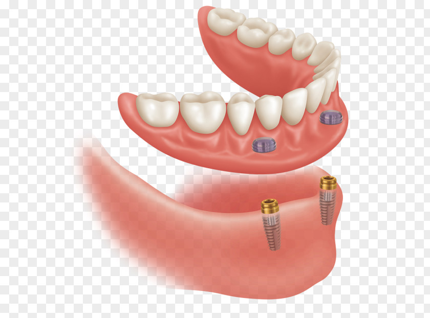 Dental Arch Implant Dentures Dentistry Abutment PNG