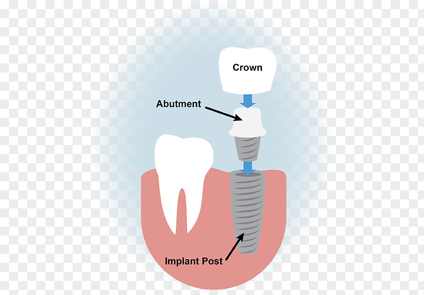 Dental Implants Implant Dentistry Surgery PNG