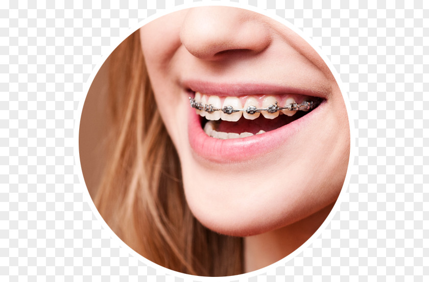 Dental Braces Dentistry Orthodontics Oral Hygiene PNG braces hygiene, health, close-up photo of woman smiling with brace clipart PNG