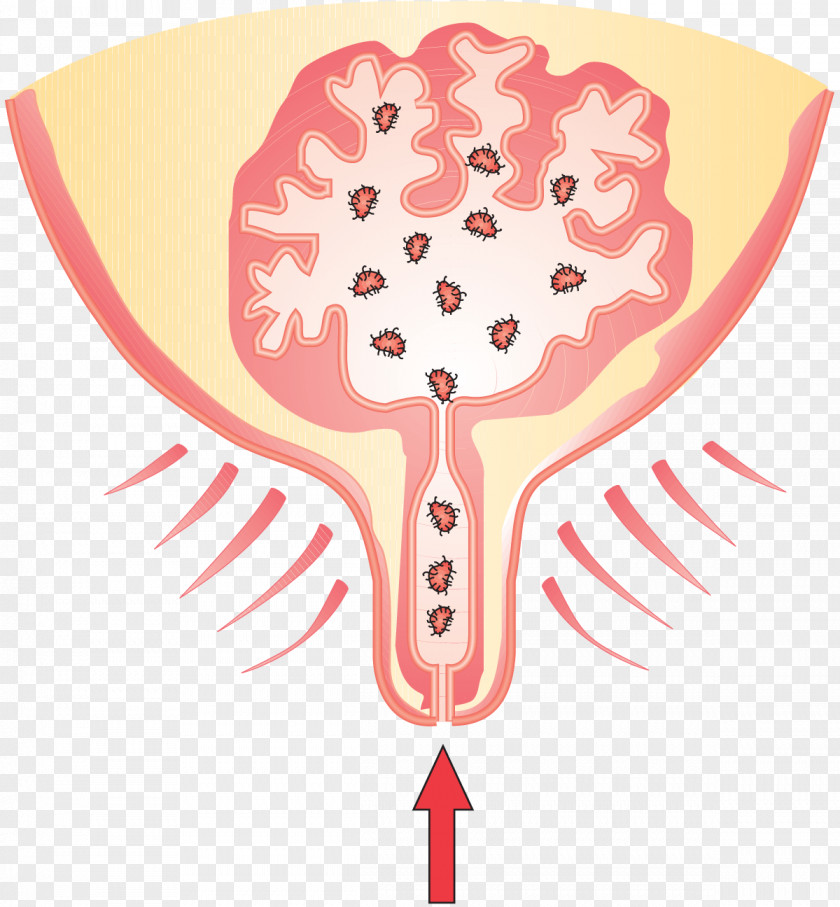 Cartoon Of Infected Bacteria Cattle Milk Mammary Gland Mastitis PNG