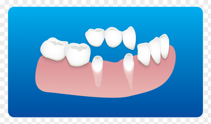 Dental Clinic Card Tooth Dentistry Implant Root Canal PNG
