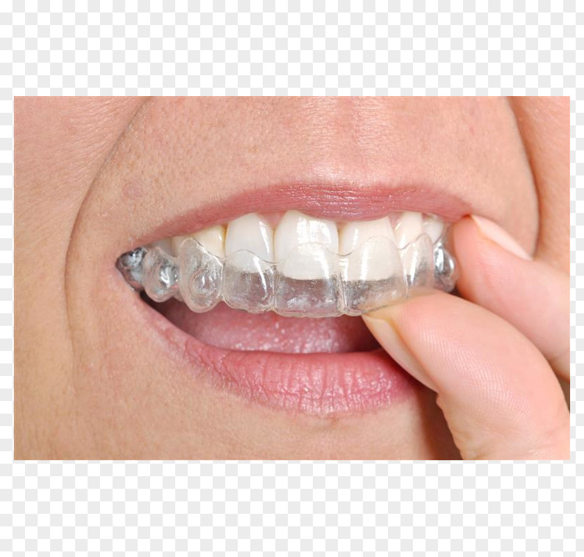 Splint Clear Aligners Cosmetic Dentistry Orthodontics Dental Braces PNG