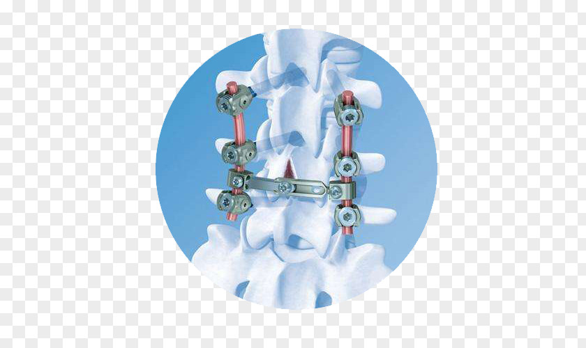 Bone Screw Vertebral Column DePuy Synthes Companies Osteosynthesis Spinal Cord Vertical Expandable Prosthetic Titanium Rib PNG