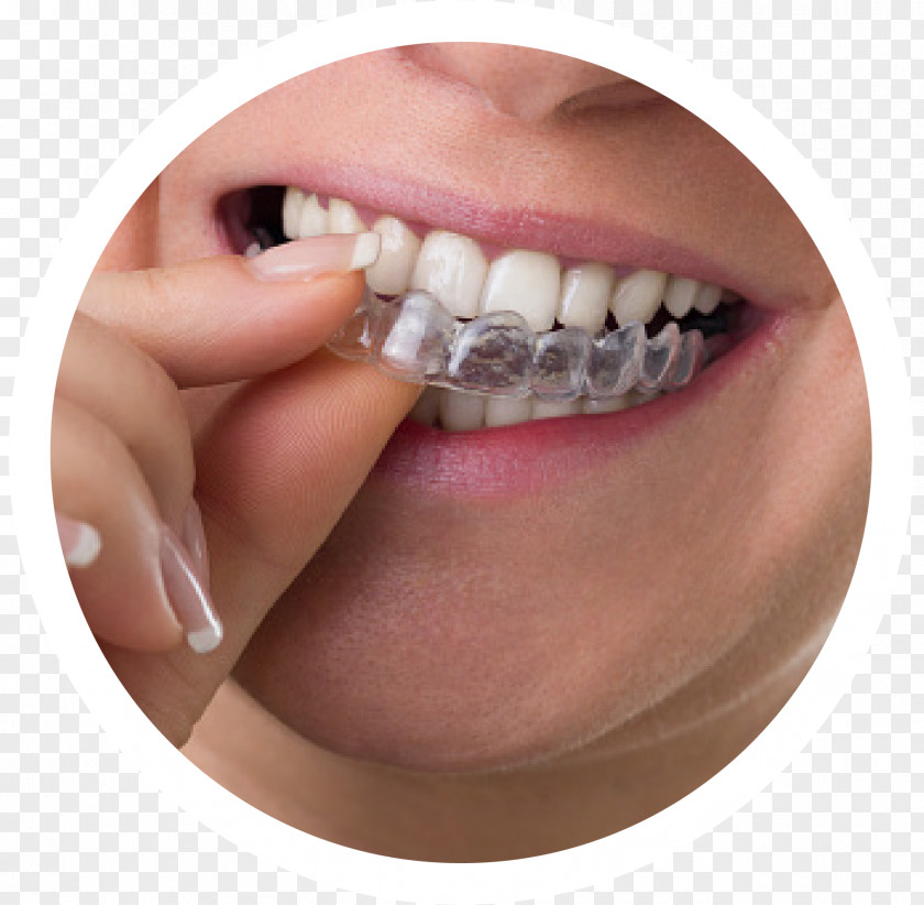 Orthodontics Clear Aligners Dental Braces Dentistry Tooth PNG