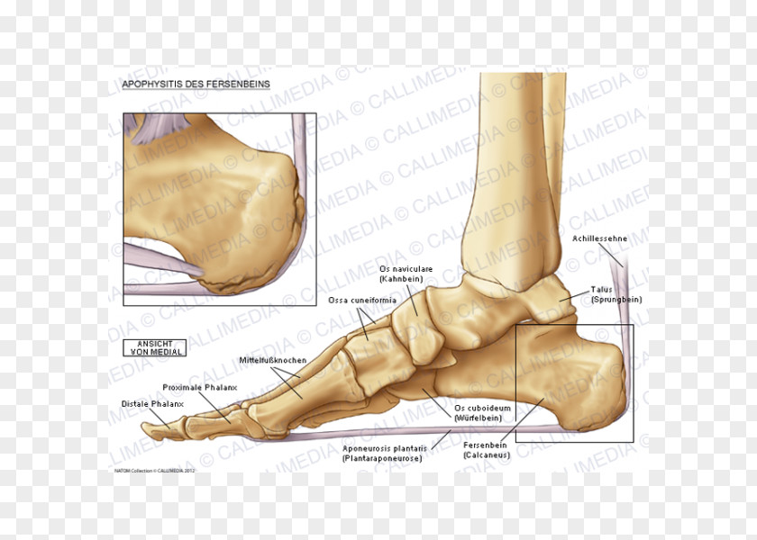 Child Foot Sever's Disease Osteochondrosis Podiatry PNG