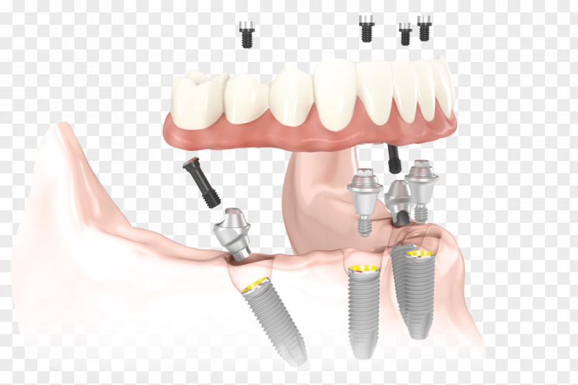 All-on-4 Dental Implant Dentistry Dentures PNG