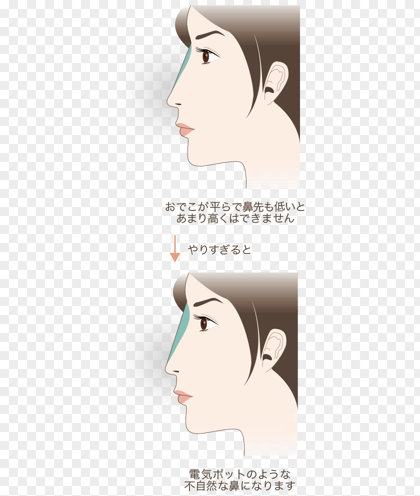 Nose Forehead Eyebrow Hyaluronic Acid 水の森美容外科 PNG