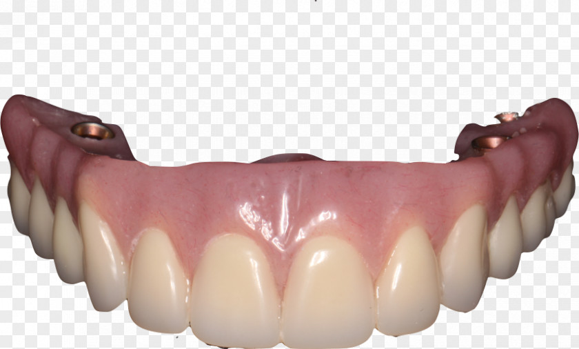 Bridge Tooth Dentures Dental Implant Removable Partial Denture PNG