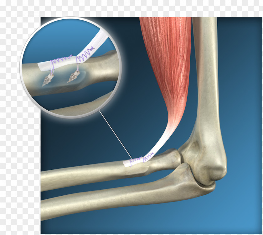 Biceps Shoulder Distal Tendon Elbow PNG