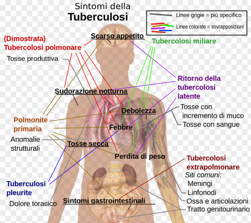 Health Tuberculosis Symptom Infection Infectious Disease PNG