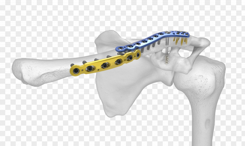 Clavicle Fracture Shoulder Bone Salter–Harris PNG