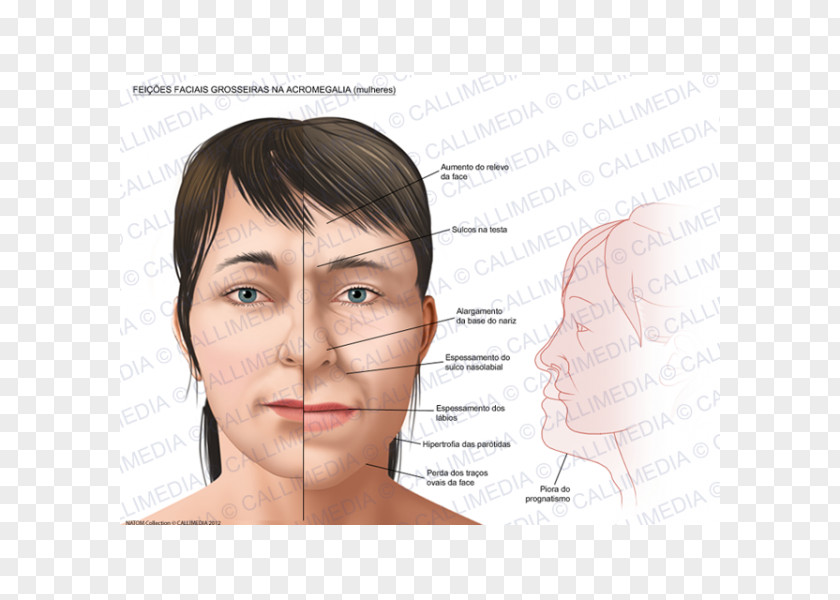 Face Acromegaly Symptom Hypertrophy Growth Hormone PNG