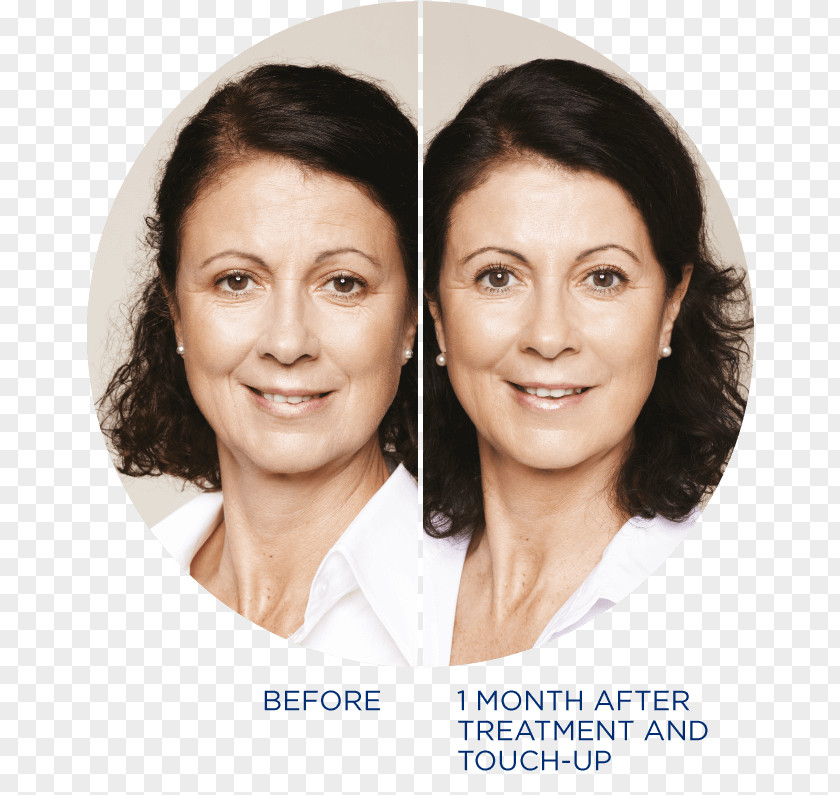 BEFORE AFTER Restylane Injectable Filler Nasolabial Fold Botulinum Toxin PNG