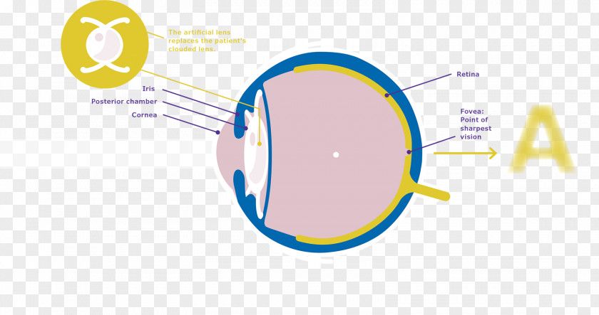 Cataract Surgery Intraocular Lens Merck Group PNG
