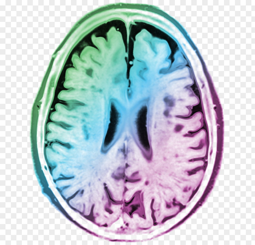 Peace Of Mind Computed Tomography Brain Organism PNG