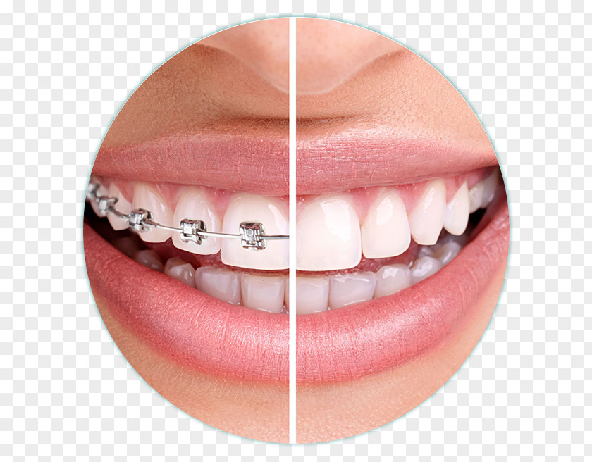 Health Dentistry Orthodontics Dental Braces Clear Aligners PNG
