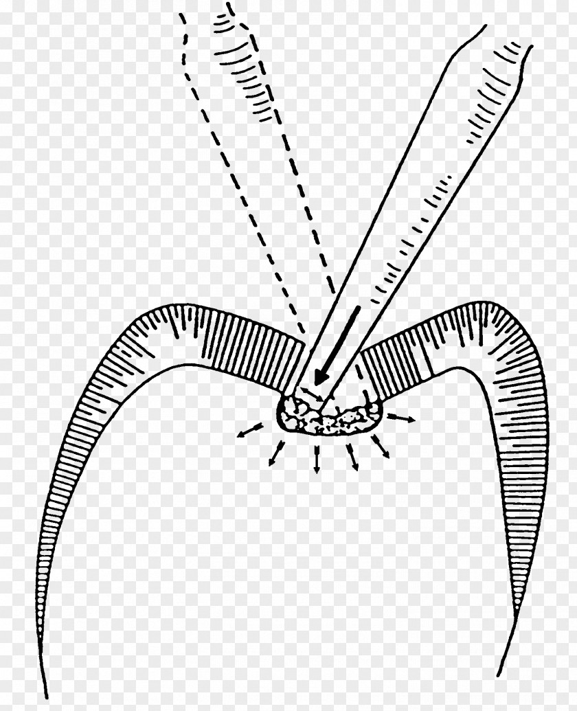 Effect Chart Of Dental Restoration /m/02csf Drawing Line Art Invertebrate Clip PNG