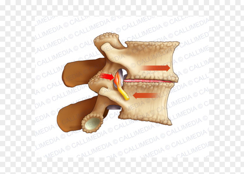 Health Osteoarthritis Lumbar Vertebrae Pain Arthrodesis Sciatica PNG