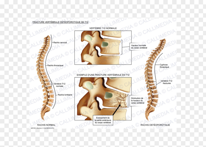 Vertebral Compression Fracture Column Bone Spinal PNG