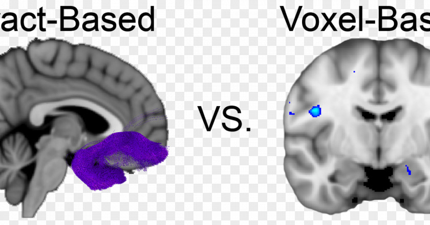 Brain Diffusion MRI Voxel-based Morphometry Magnetic Resonance Imaging White Matter PNG