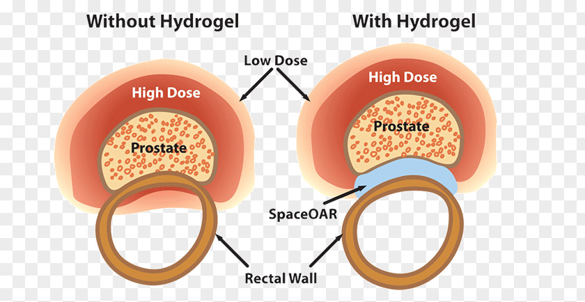 Prostate Gland Radiation Therapy Cancer Hydrogel Treatment Of PNG