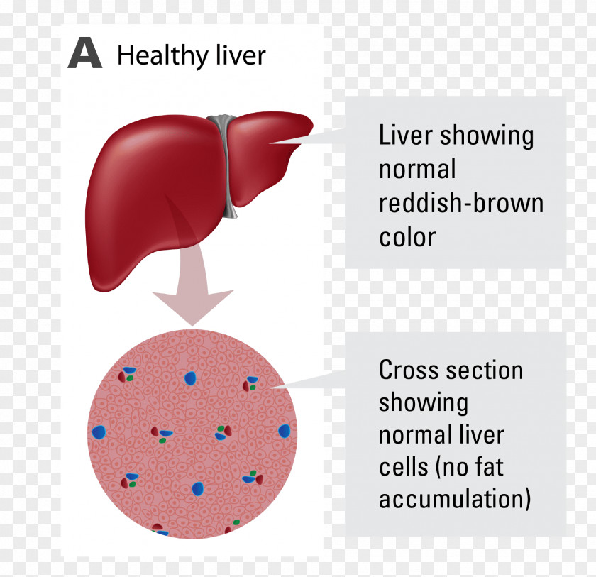 Liver Non-alcoholic Fatty Disease Alcoholic PNG