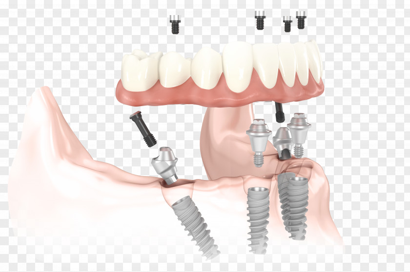 Dental Implant All-on-4 Dentistry Dentures PNG