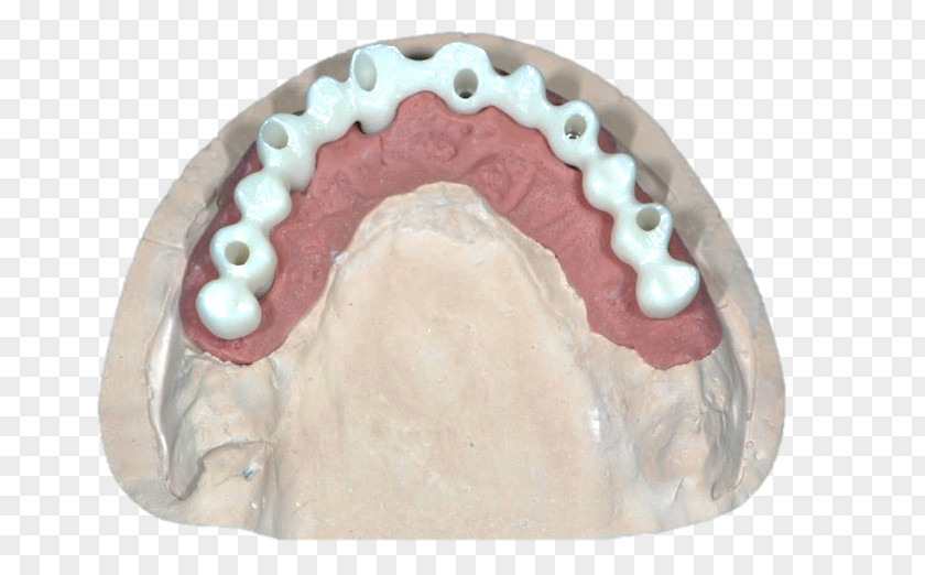 Bridge Jaw Dental Implant Diagnostic Wax-up Zirconium Dioxide PNG