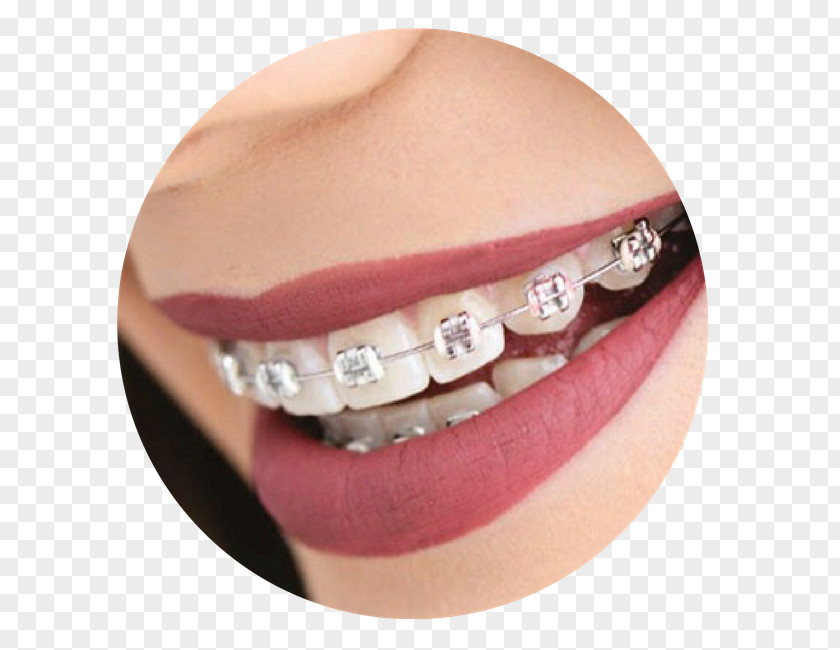 Sorriso Dentes Dental Braces Tooth Dentistry Video PNG